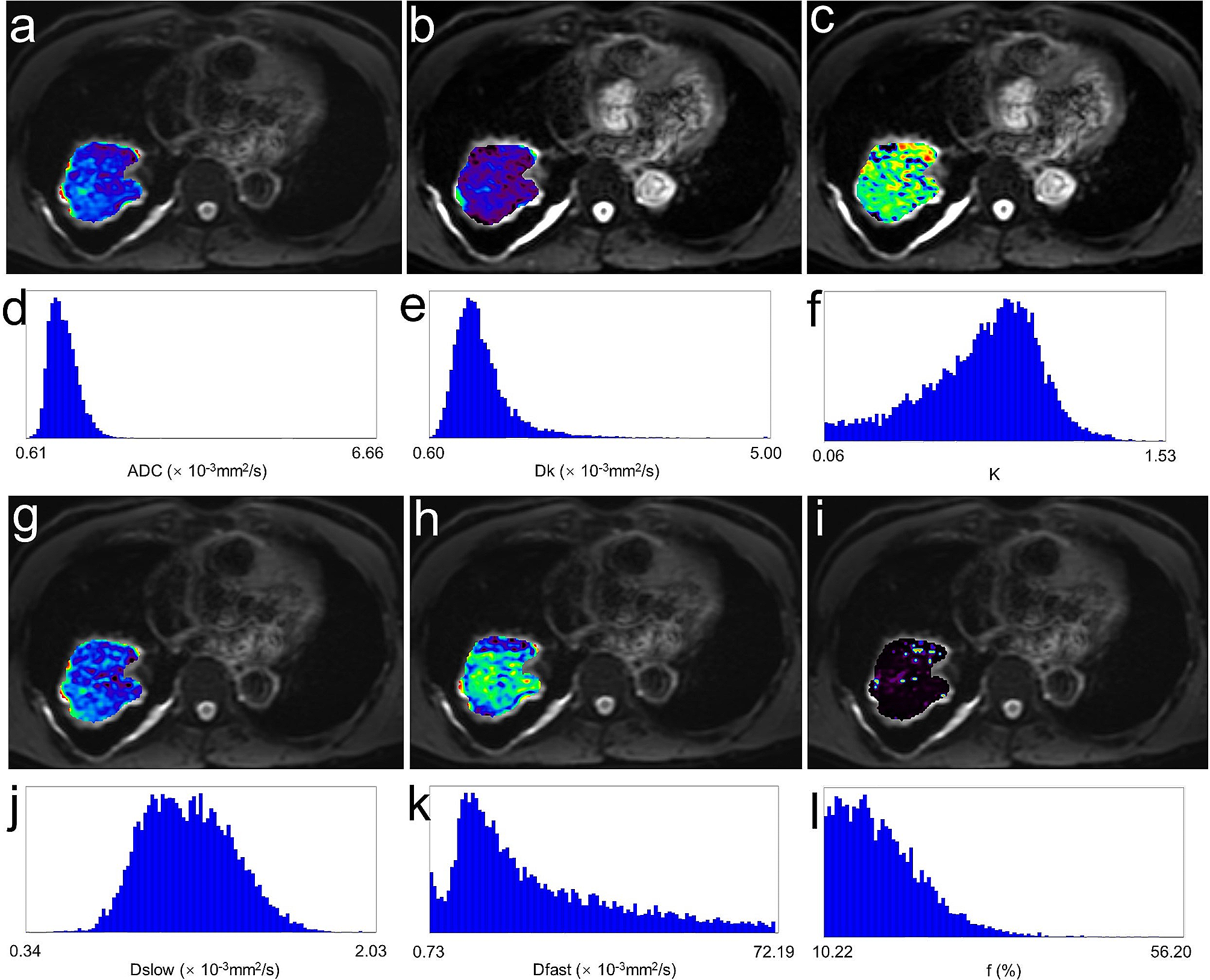 Histogram analysis of multiple diffusion models for predicting advanced non-small cell lung cancer response to chemoimmunotherapy