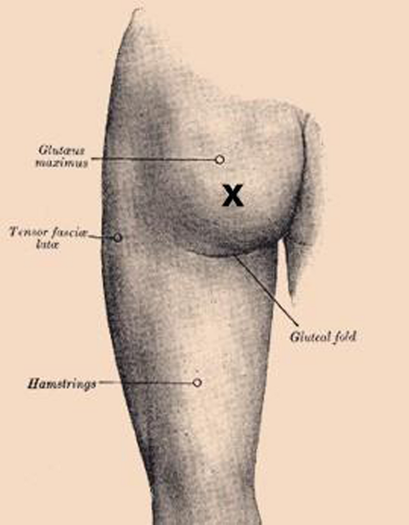 Migrated tubal sterilisation clip presenting as a subcutaneous gluteal foreign body 24 years later: a case report and literature review