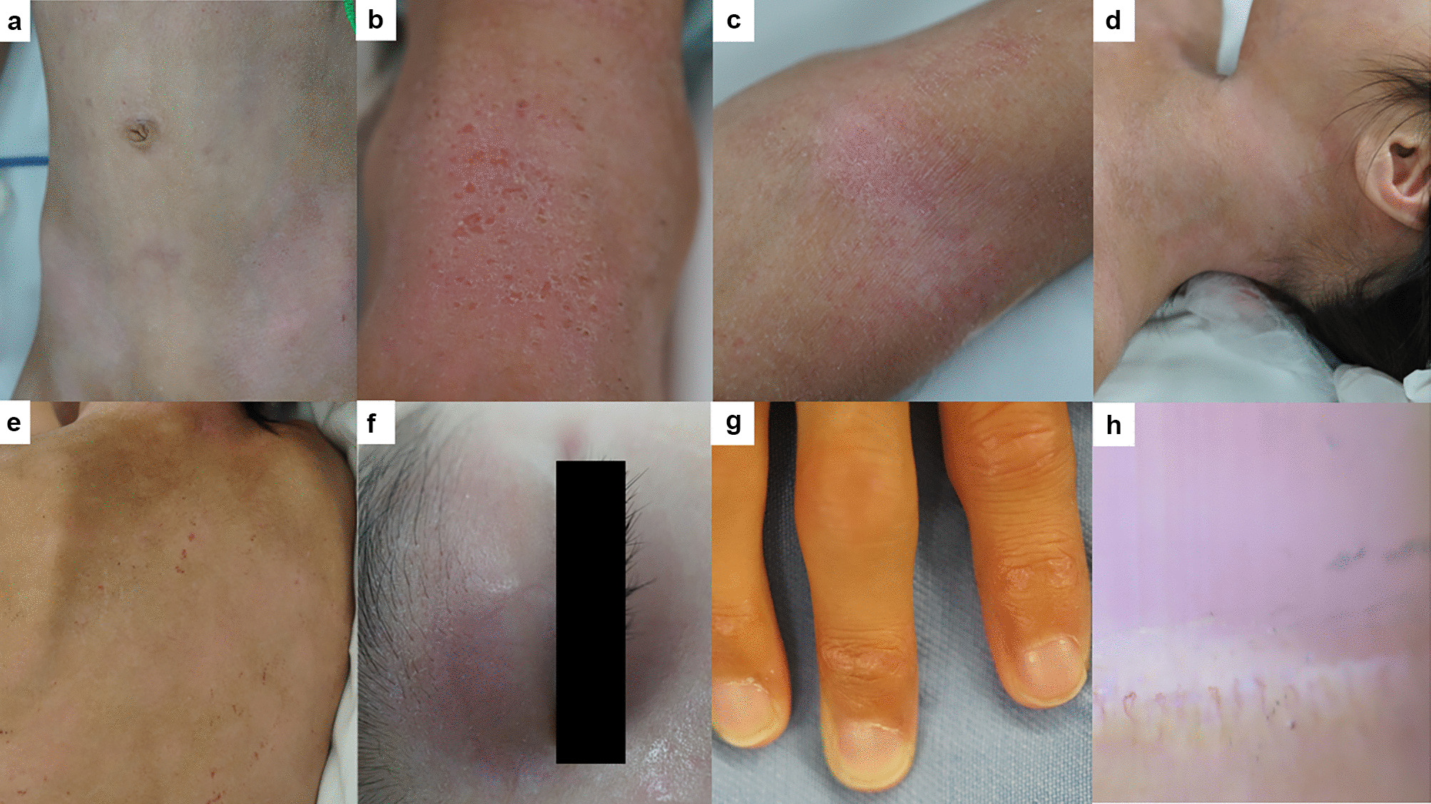 Anti-TIF-1γ Positive Juvenile Dermatomyositis Diagnosed with Atopic Dermatitis
