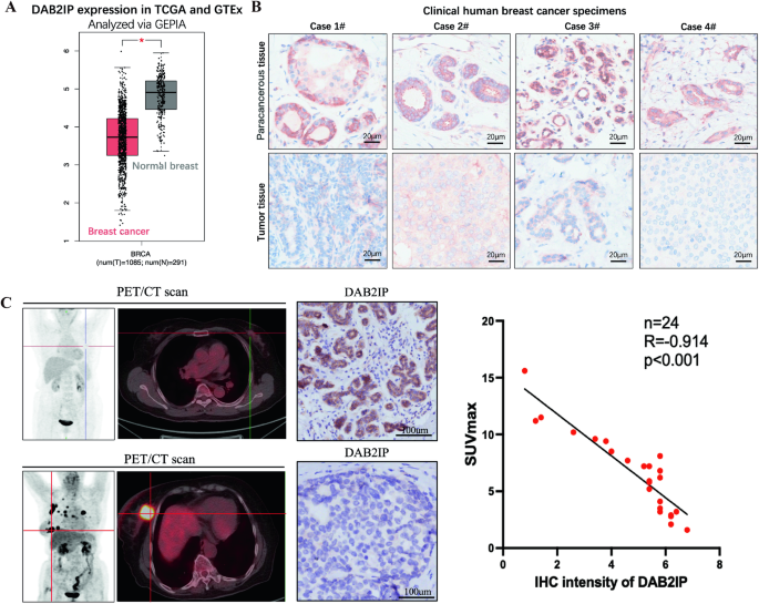 DAB2IP inhibits glucose uptake by modulating HIF-1α ubiquitination under hypoxia in breast cancer