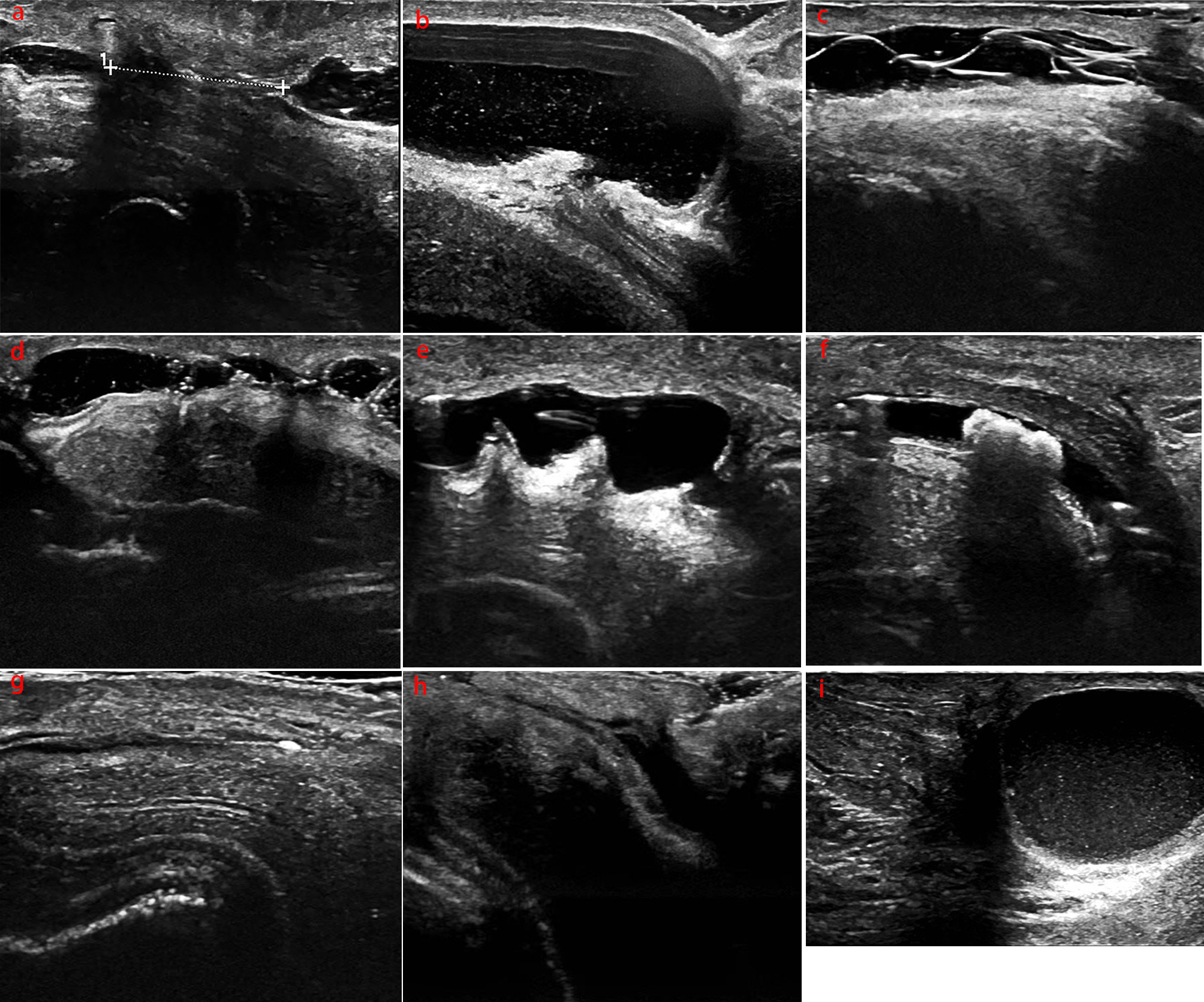 Evaluation of postoperative complications of hypospadias using high-frequency ultrasound imaging