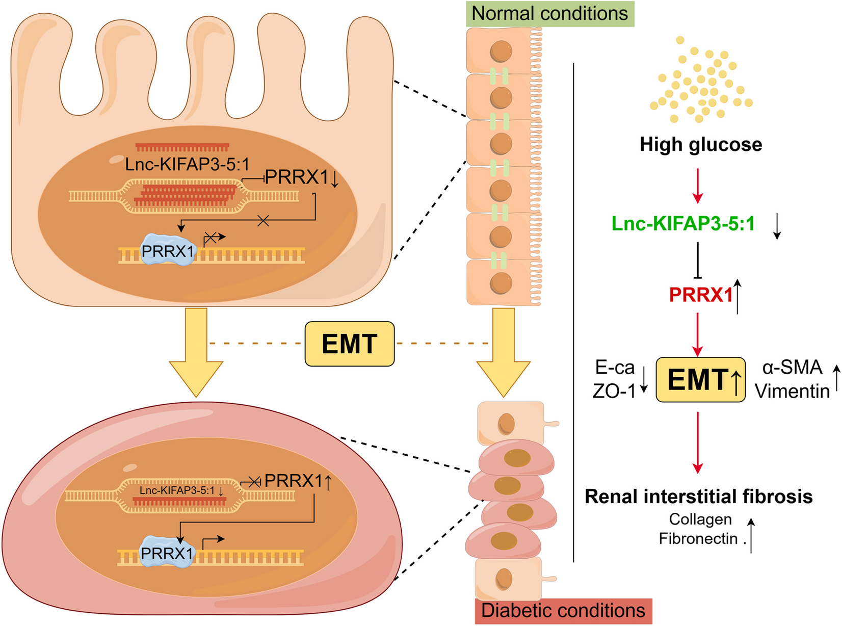 LncRNA KIFAP3-5:1 inhibits epithelial-mesenchymal transition of renal tubular cell through PRRX1 in diabetic nephropathy