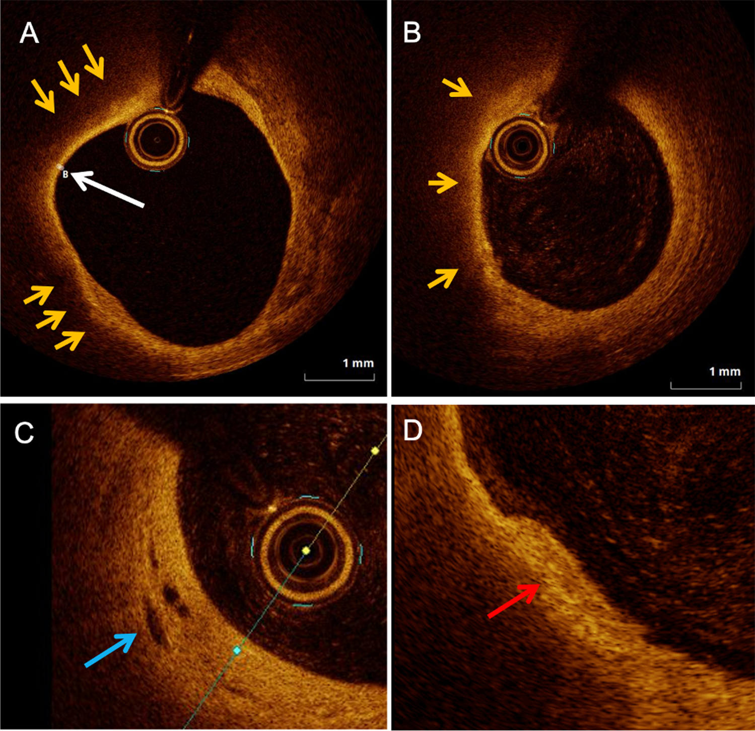 Optical Coherence Tomography in the Assessment and Management of Cardiac Allograft Vasculopathy
