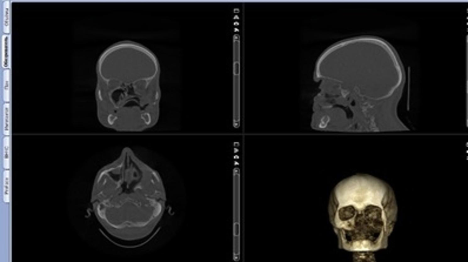 Prosthetic rehabilitation of patients with maxillary oncology defects using zygomatic implants