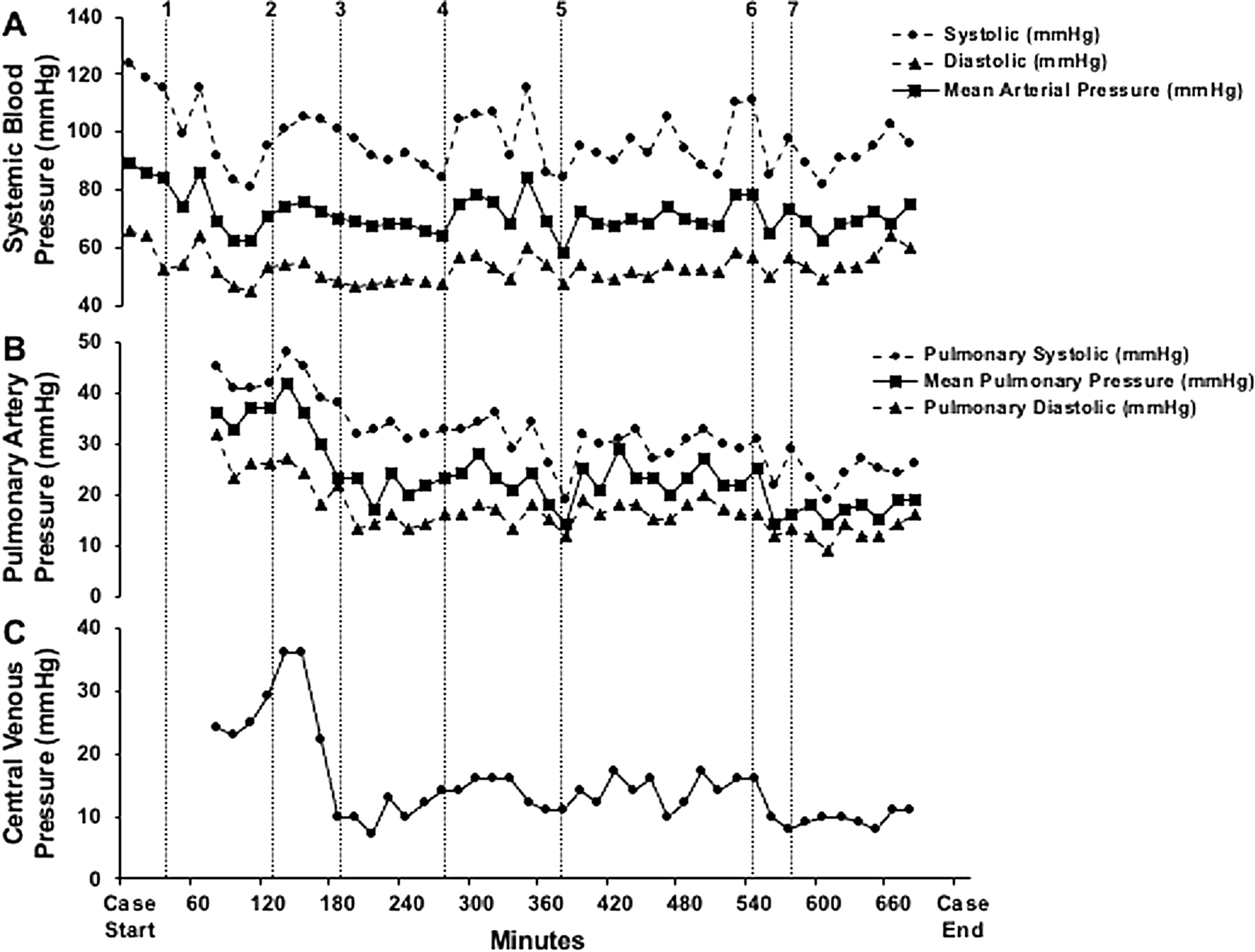 Intraoperative hemodialysis with supra- and infradiaphragmatic catheters for liver transplantation