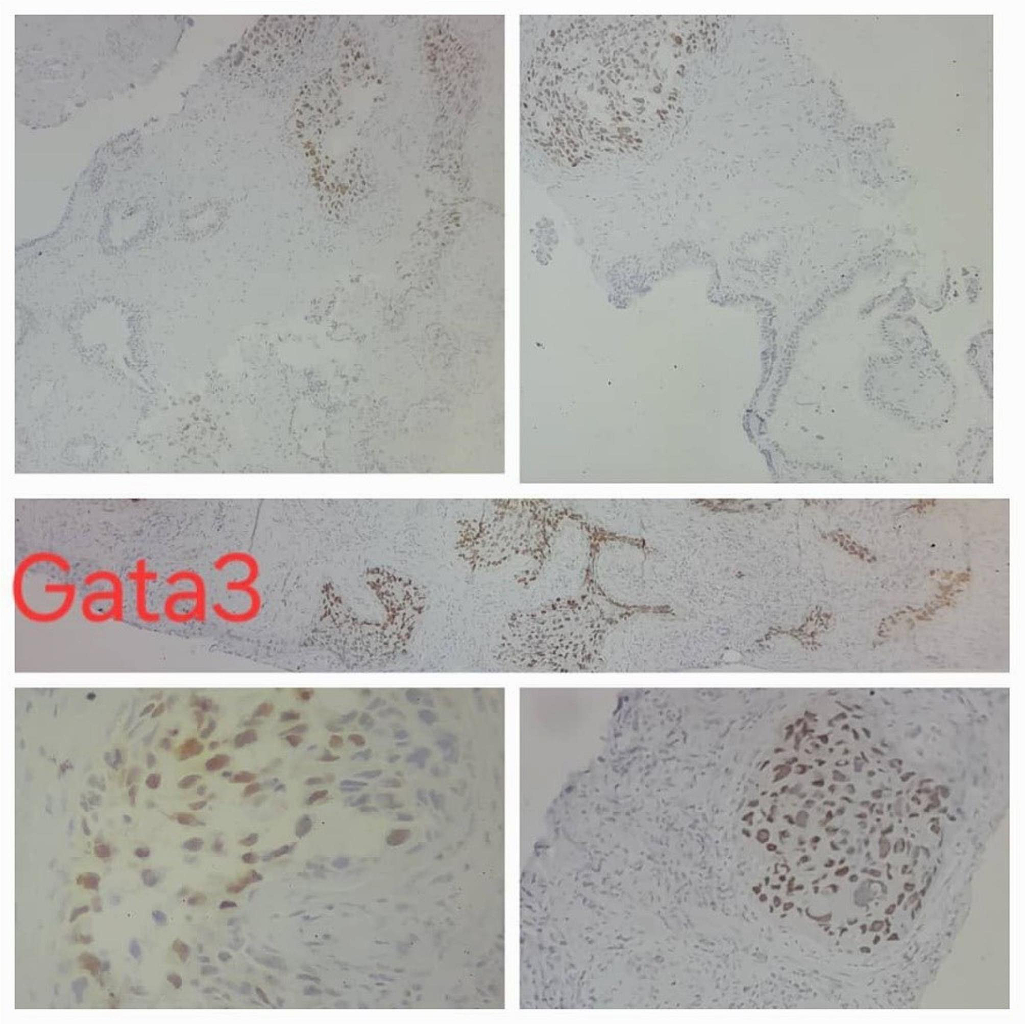 Carcinoma in situ within the bladder trigone with an isolated metastasis to the prostate without involvement of prostatic urethra: a unique case report