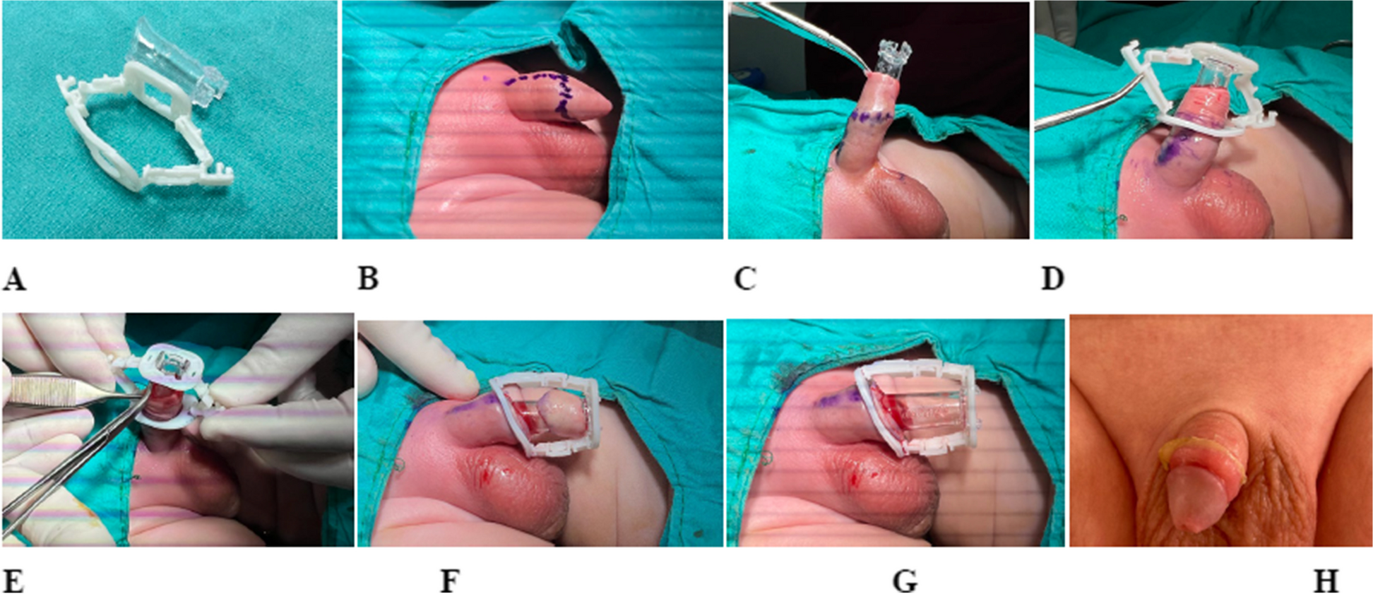 Comparative analysis of two methods in circumcision: a new disposable device versus classic sleeve technique