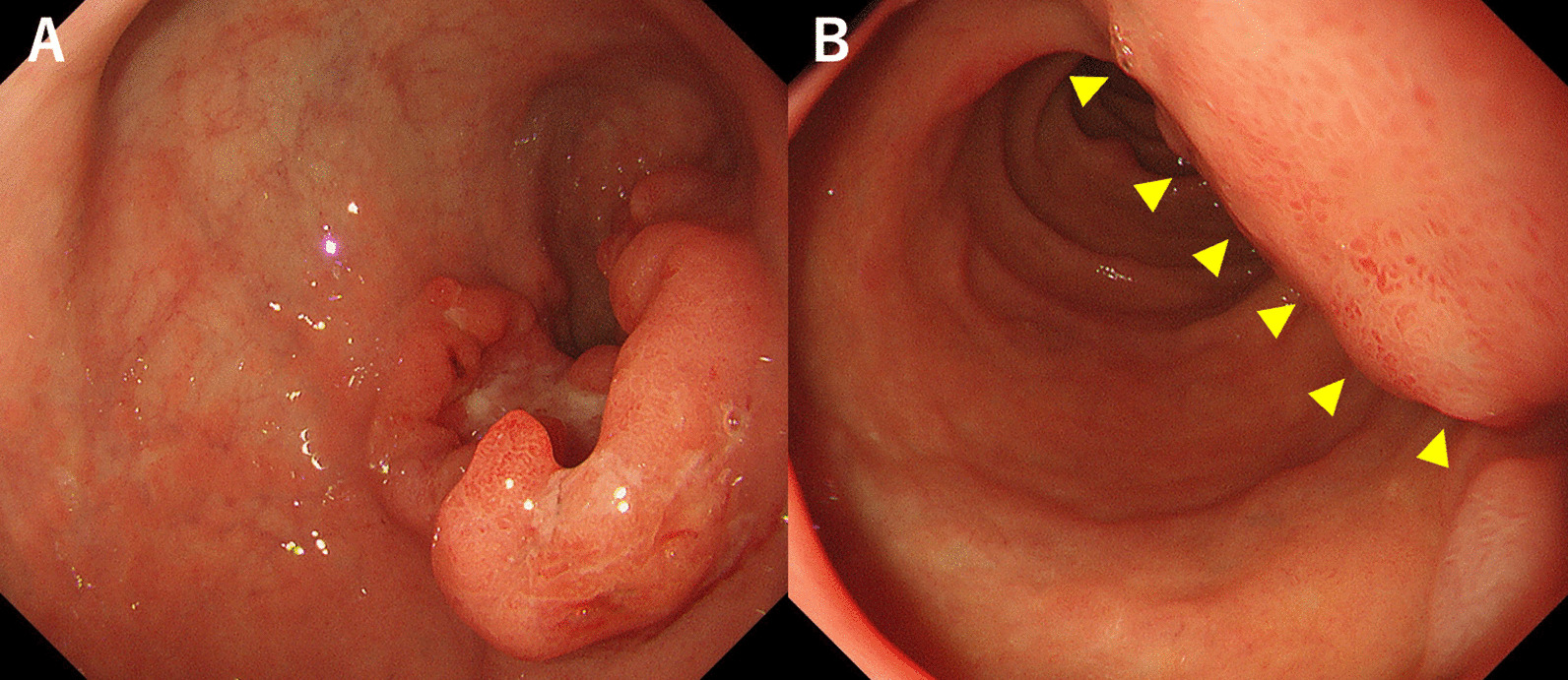 Minimally invasive elective gastrectomy after preoperative chemotherapy in a patient with frailty who presented with locally far advanced-stage gastric cancer: a case report