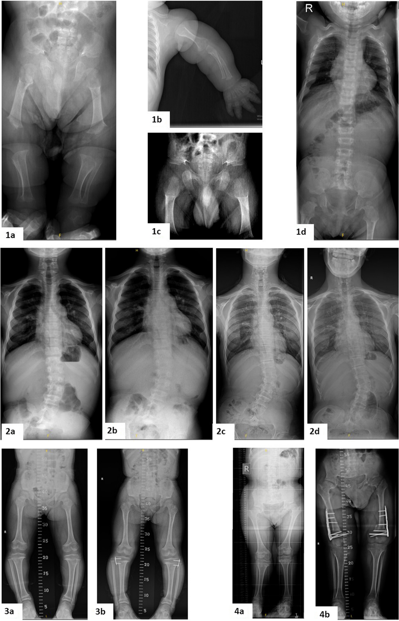 Review of patients with achondroplasia: a single-center's experience with follow-up and associated morbidities