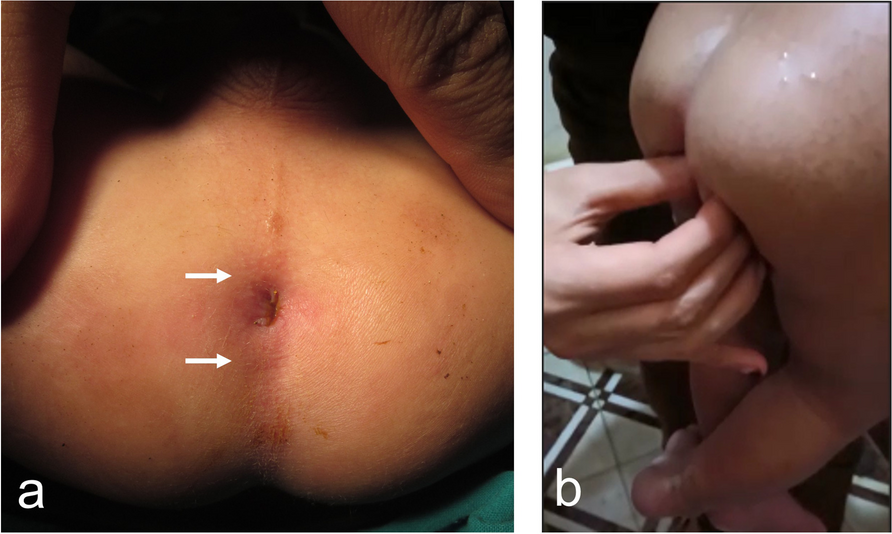 Overlooked anterior anal misplacement: a ‘forme fruste’ anomaly and potentially correctable cause of constipation
