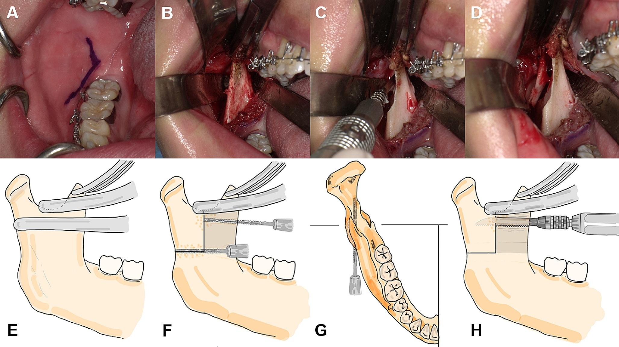 Improvement of the temporomandibular joint symptoms due to the condylar position change following modified L-shaped intraoral vertico-sagittal ramus osteotomy: a single-center, retrospective study