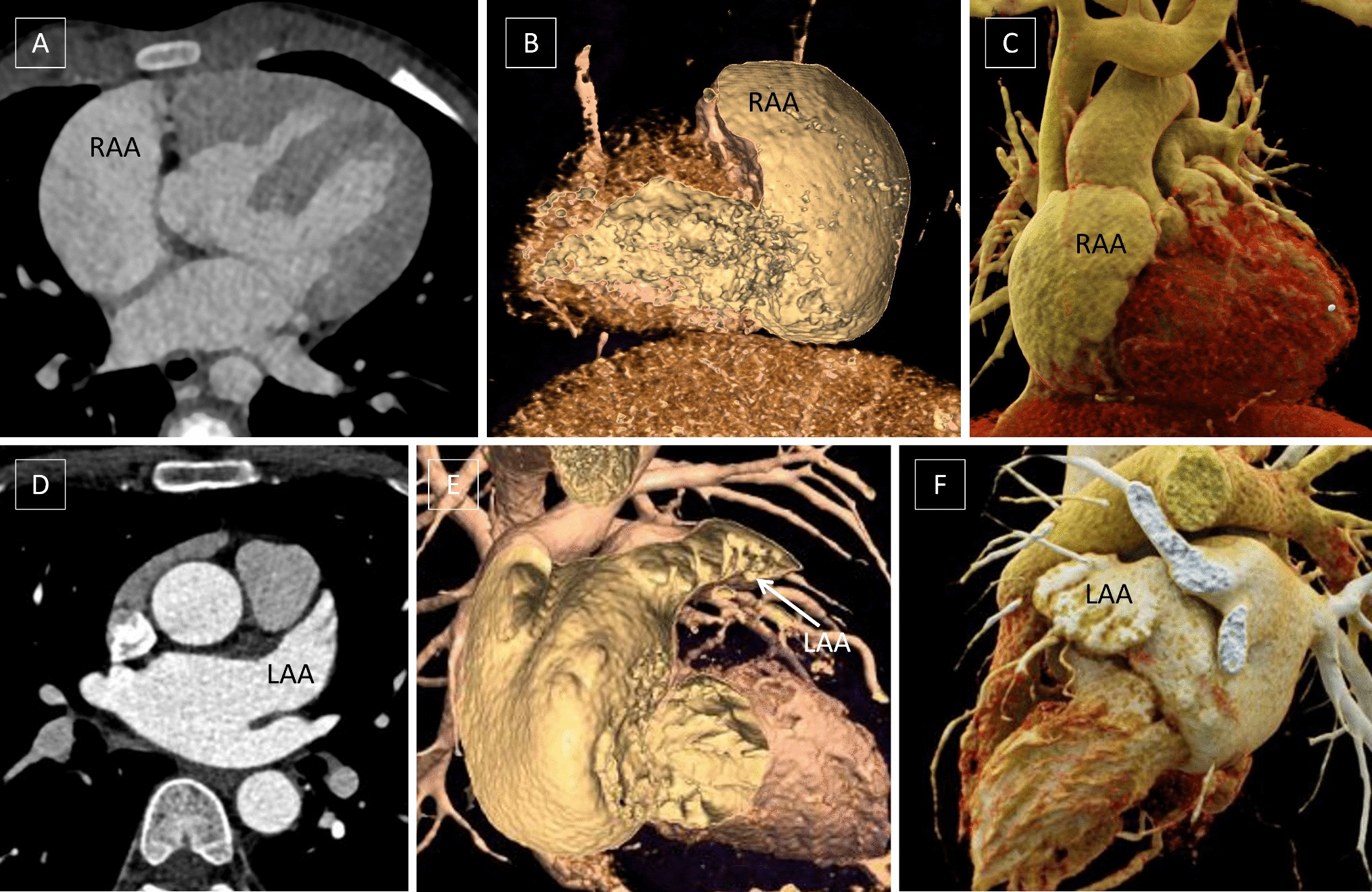 Identification and Analysis of Atrial-Bronchial-Abdominal Disharmony in Patients with Isomeric Atrial Appendages