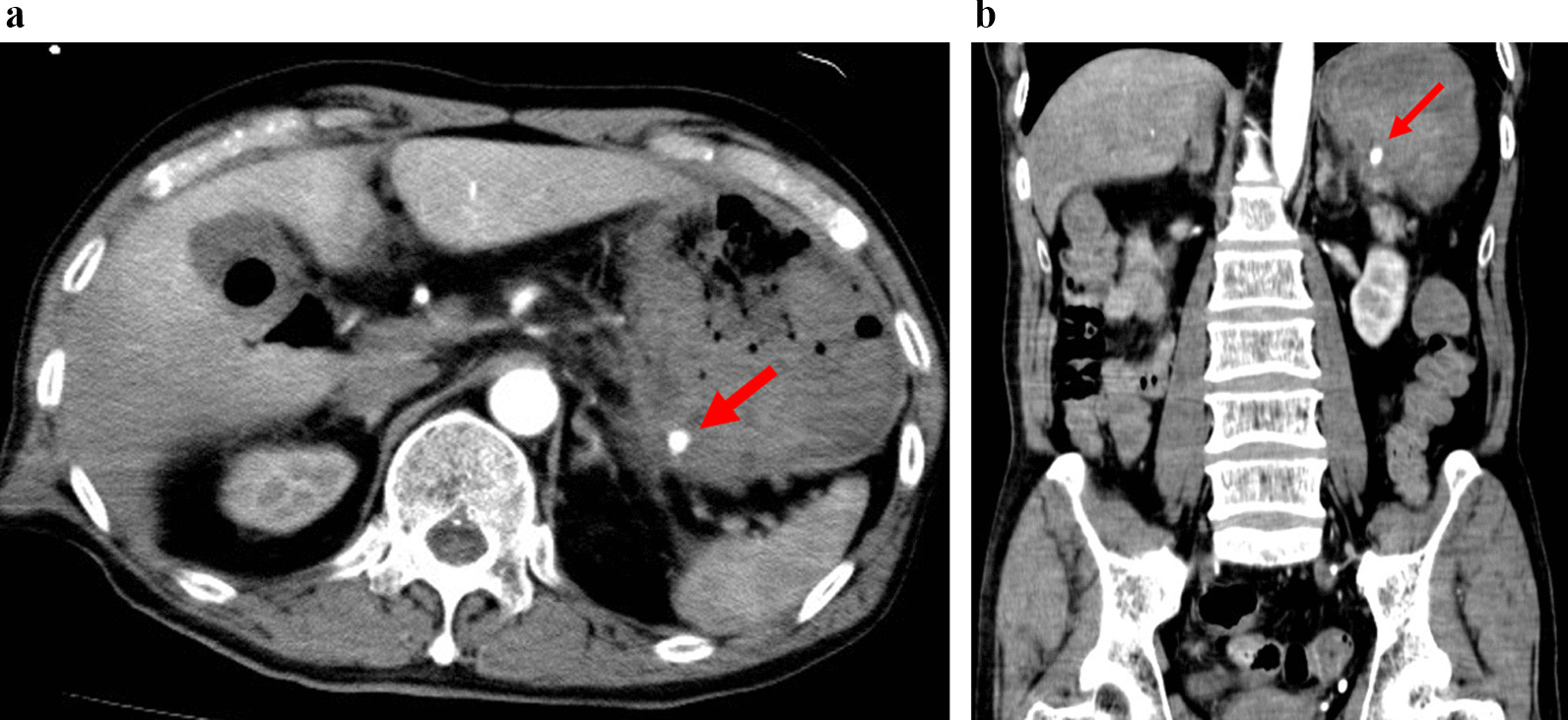 Gastric rupture caused by intragastric perforation of splenic artery aneurysm: a case report and literature review