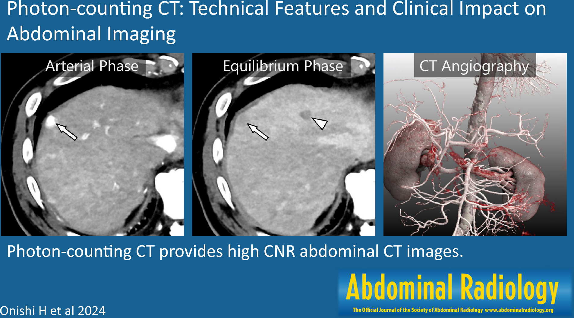 Photon-counting CT: technical features and clinical impact on abdominal imaging