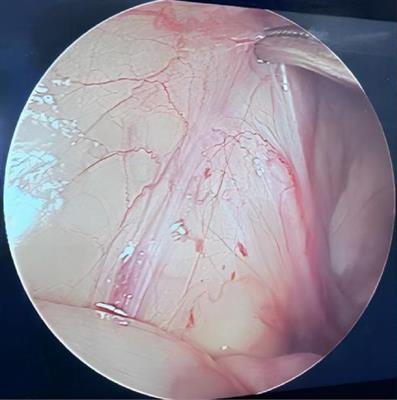 Does the presence of blind-ended vas deferens and spermatic vessels in laparoscopic exploration of non-palpable testes conclusively indicate testicular absence?