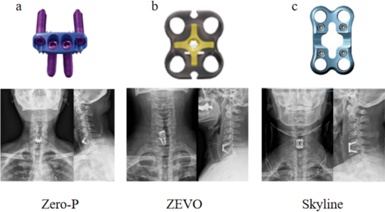 Zero-profile implant system versus novel plate systems after ACDF for comparison of sagittal balance parameters and clinical efficacy analysis