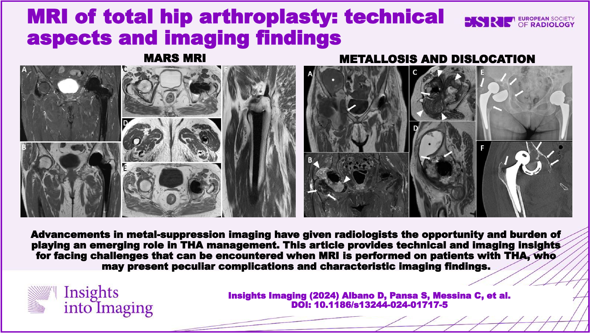 MRI of total hip arthroplasty: technical aspects and imaging findings