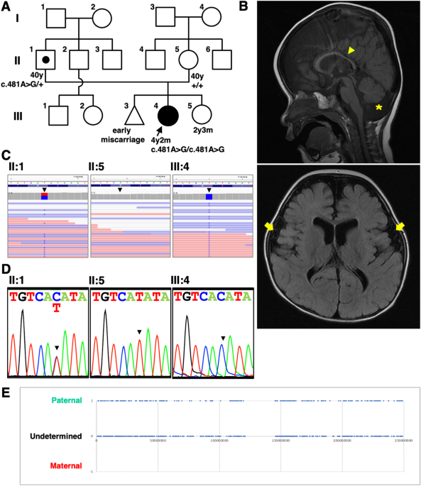 A novel homozygous variant of the PIGK gene caused by paternal disomy in a patient with neurodevelopmental disorder, cerebellar atrophy, and seizures