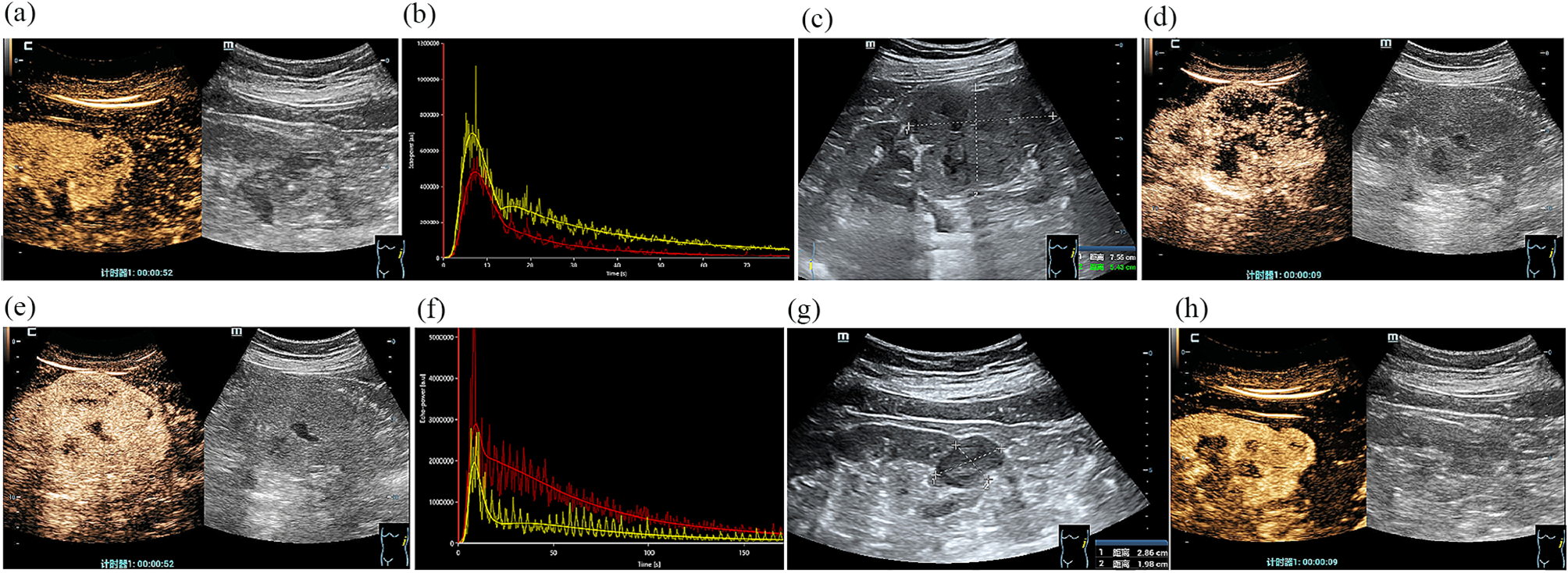 Qualitative and quantitative assessment of non-clear cell renal cell carcinoma using contrast-enhanced ultrasound