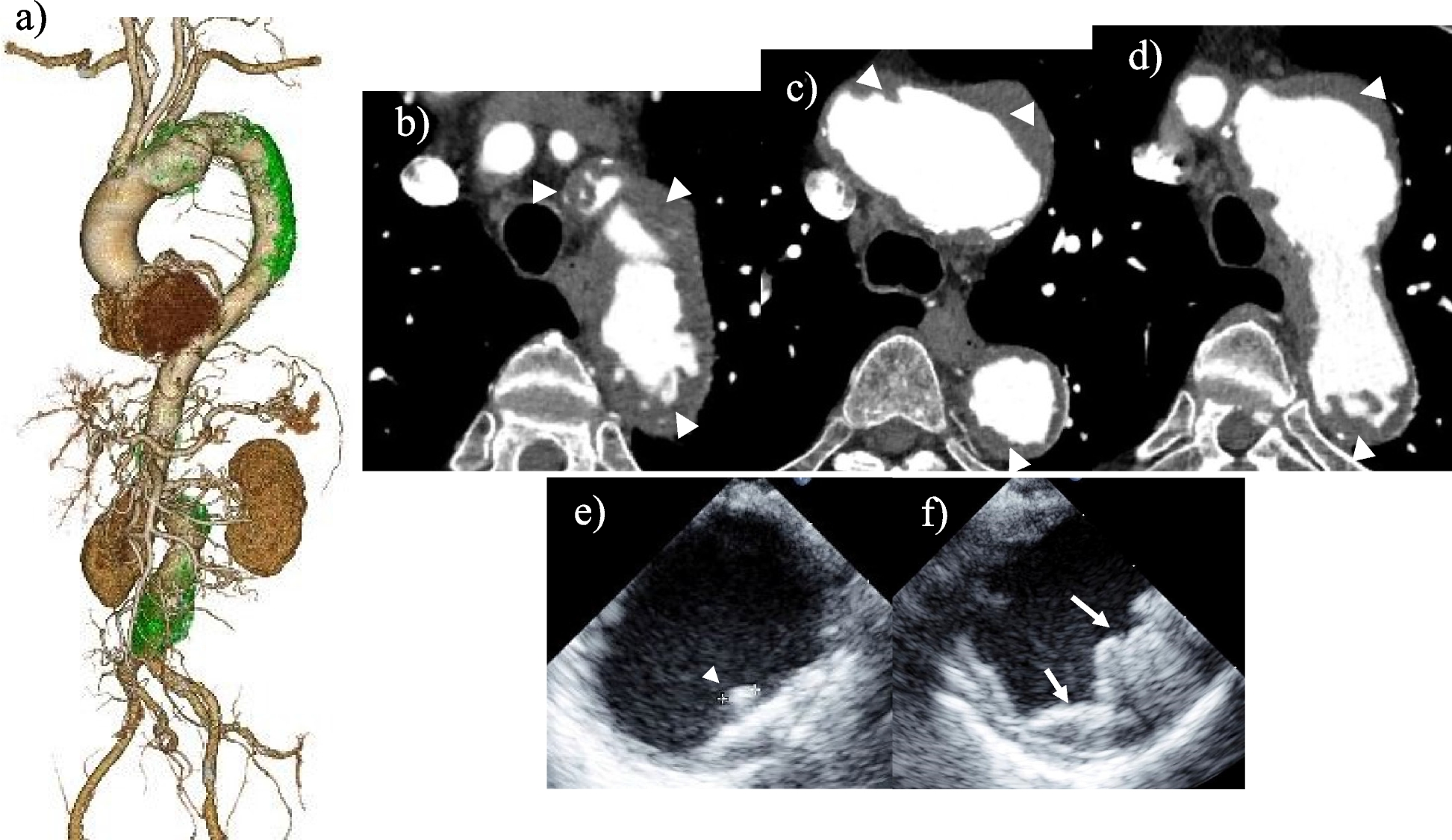 Two-stage hybrid surgical repair for aortic arch pathology with a shaggy aorta: a case report