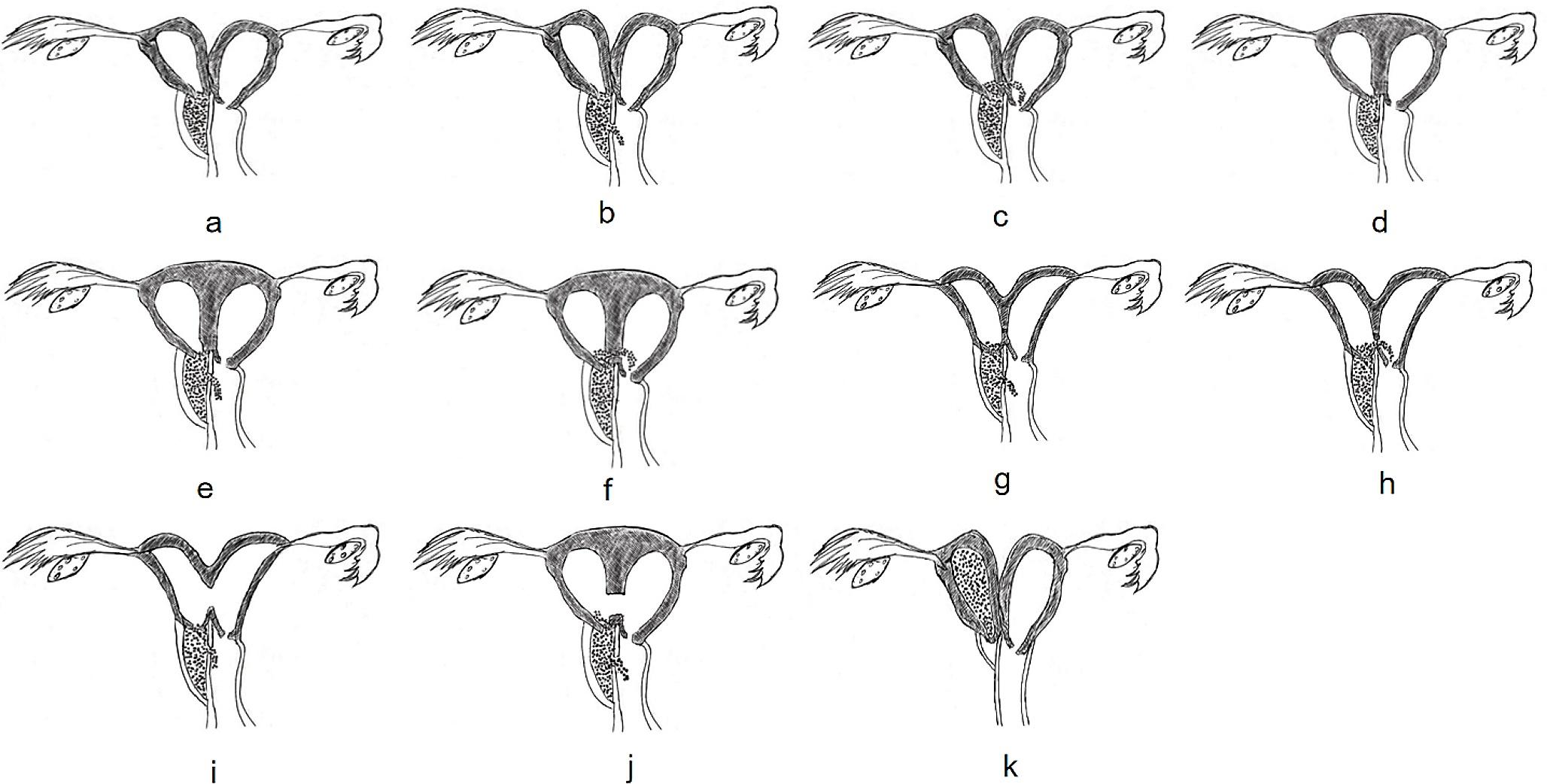 Clinical and Imaging Characteristics of Herlyn-Werner-Wunderlich Syndrome: a Comprehensive Analysis