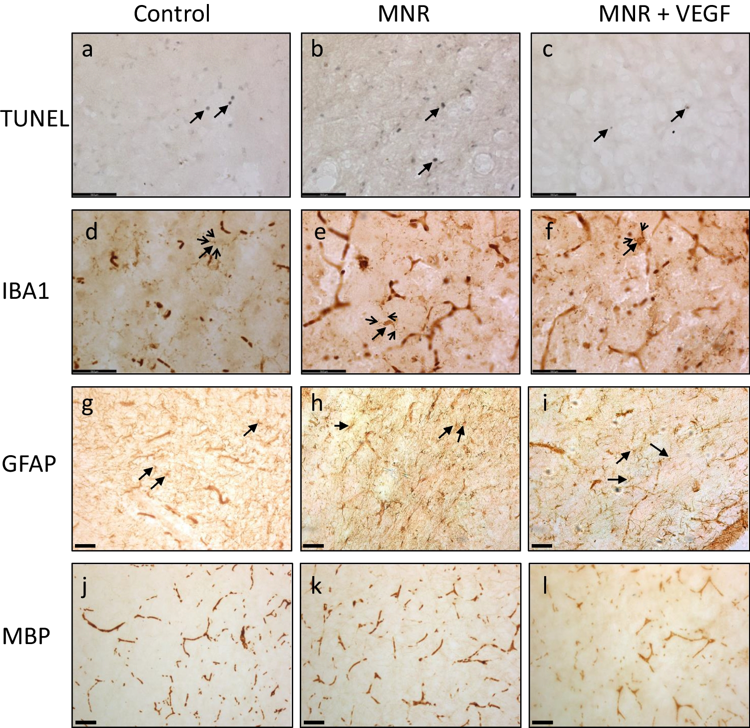 Maternal Uterine Artery Adenoviral Vascular Endothelial Growth Factor (Ad.VEGF-A165) Gene Therapy Normalises Fetal Brain Growth and Microglial Activation in Nutrient Restricted Pregnant Guinea Pigs