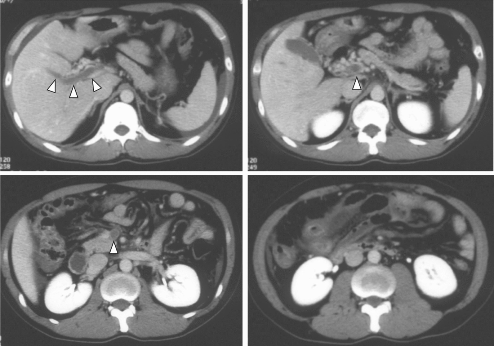 Recanalization of port-superior mesenteric vein thrombosis with long-term anticoagulant therapy after failed early anticoagulant therapy