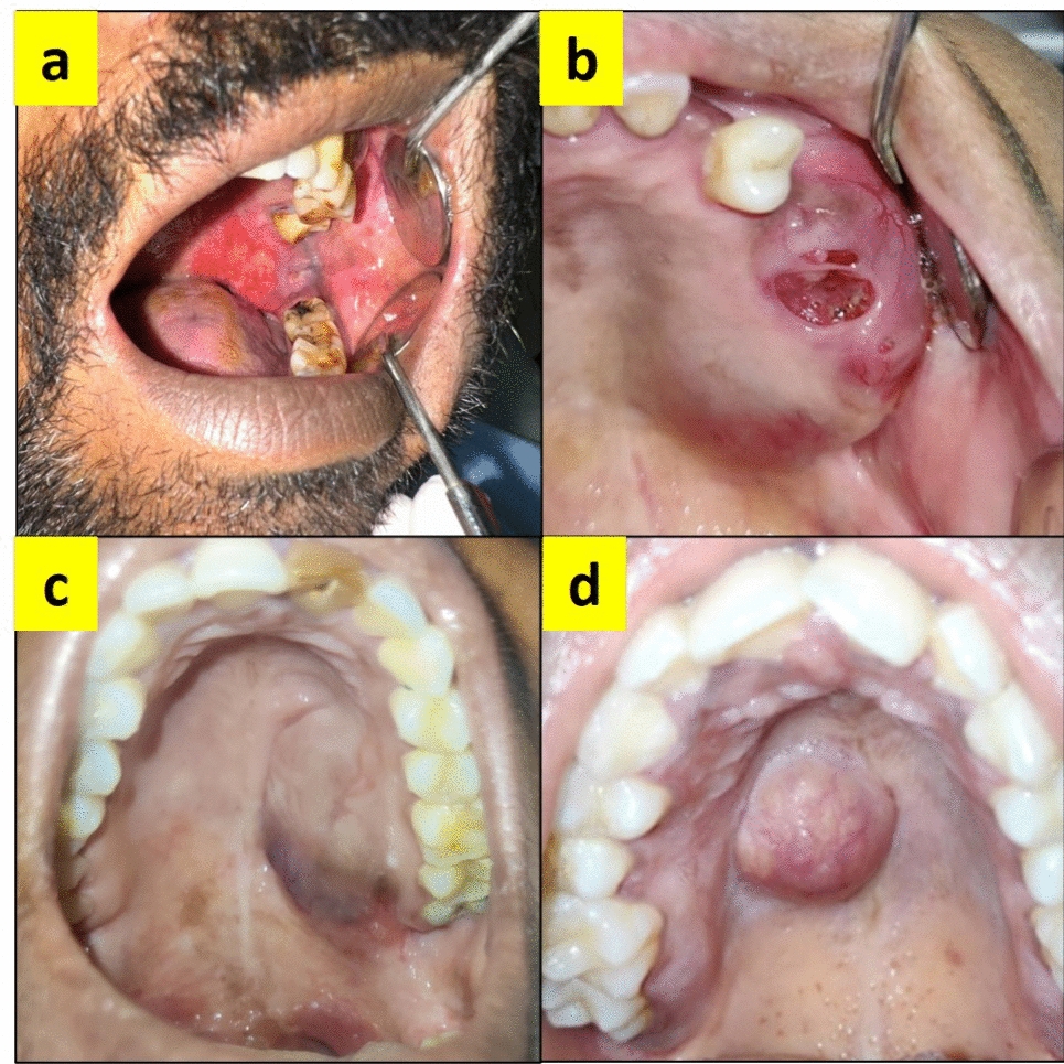 Exercise Caution with Palatal Swelling: A Case Series on Minor Salivary Gland Tumours