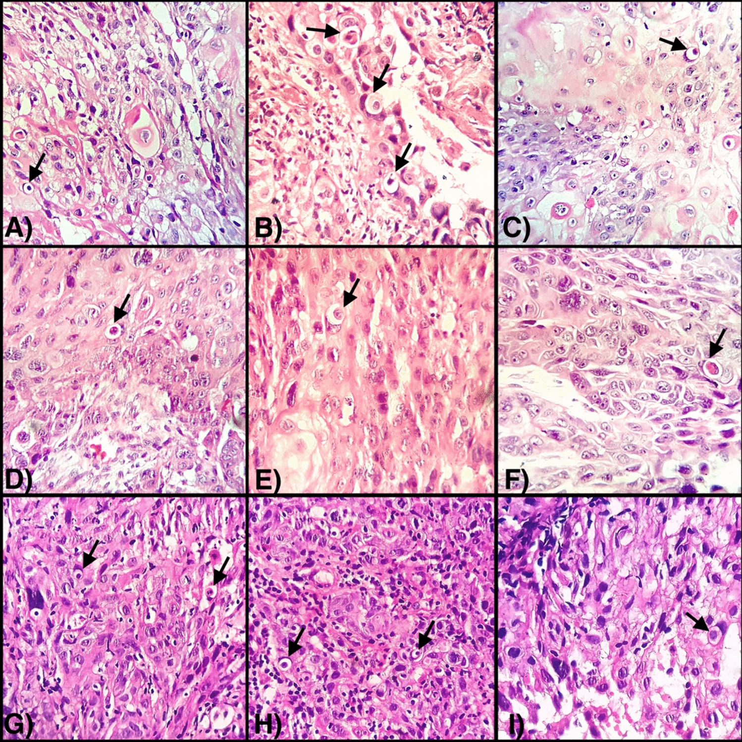 Association of Cellular Cannibalism with Immunohistochemical Expression of CD31, CD68 and BCL2 in Oral Squamous Cell Carcinoma: An Observational Study