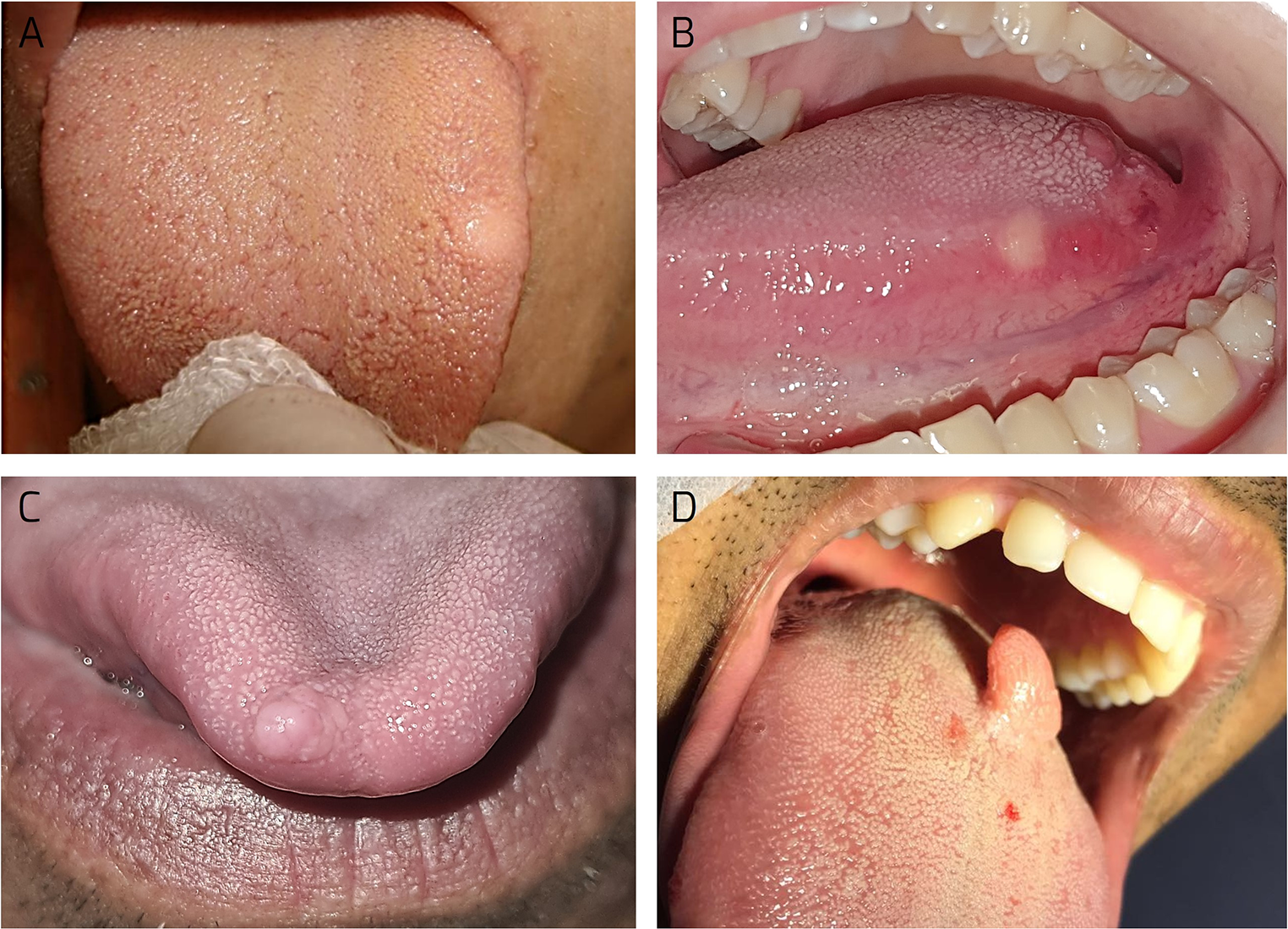 Oral granular cell tumor: a collaborative clinicopathological study of 61 cases