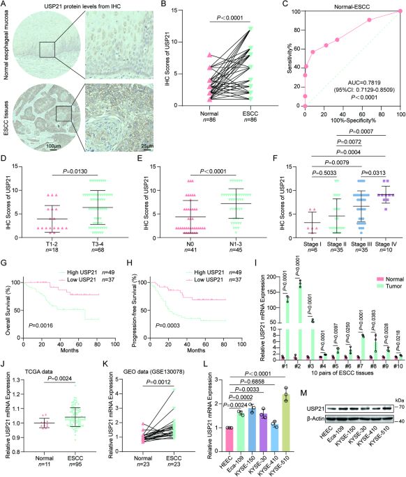 USP21-mediated G3BP1 stabilization accelerates proliferation and metastasis of esophageal squamous cell carcinoma via activating Wnt/β-Catenin signaling