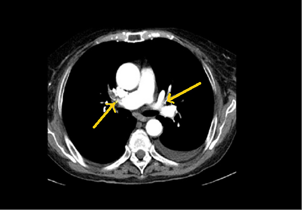 Unprovoked venous thromboembolism recurrence and arterial embolism revealing lung cancer: a case report