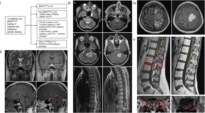 Clinical features and outcomes in primary nervous system histiocytic neoplasms