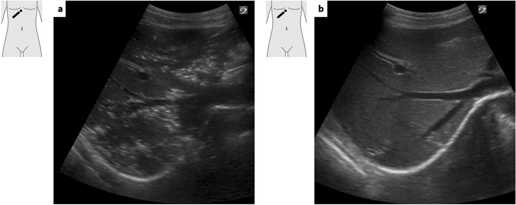 A case of portal vein gas due to accidental ingestion of hydrogen peroxide: the importance of performing ultrasound examinations over time