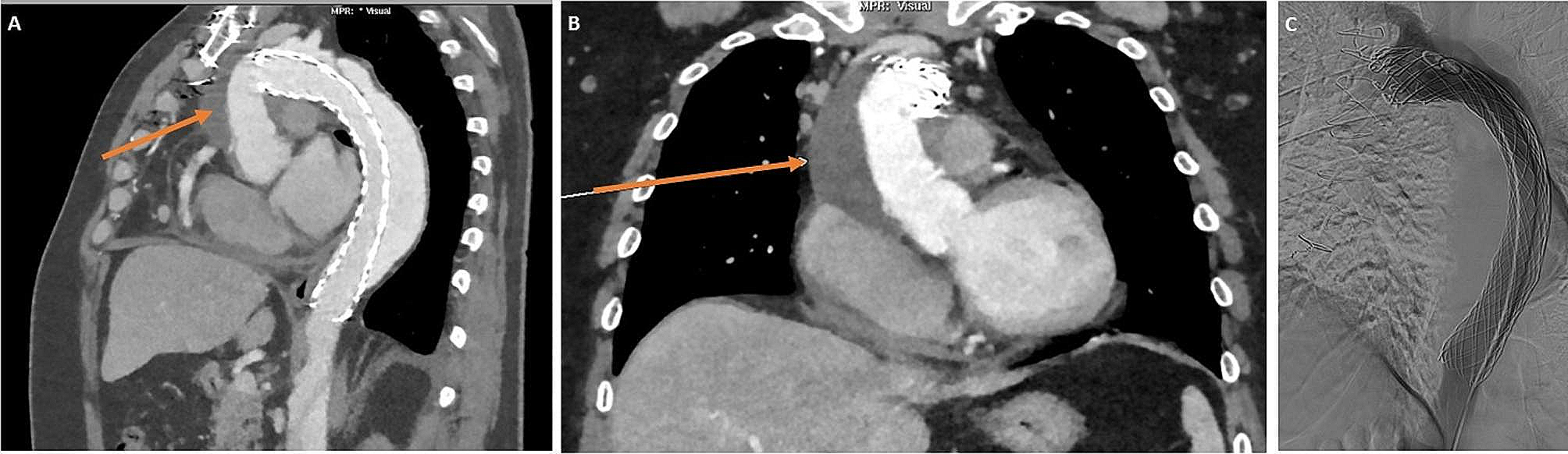 Aortic arch de-branching for suspected expanding perigraft haematoma after previous acute type-A dissection repair with AMDS stent: a technique for a potential future problem