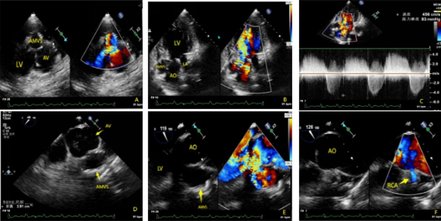 Echocardiographic features of a giant aneurysm of membranous ventricular septum