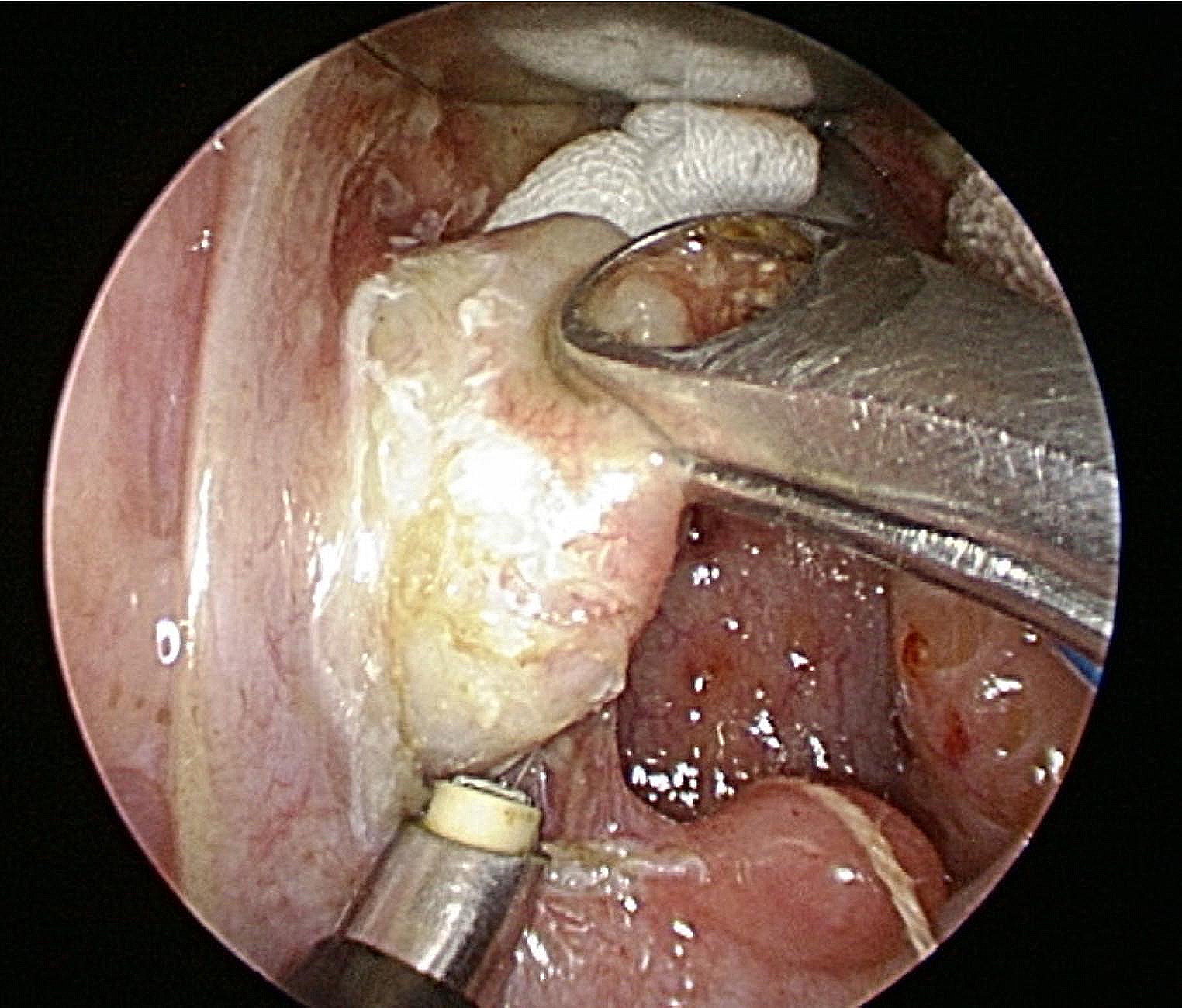Rare Pathology: Choristoma of the Palatine Tonsil in Otorhinolaryngology