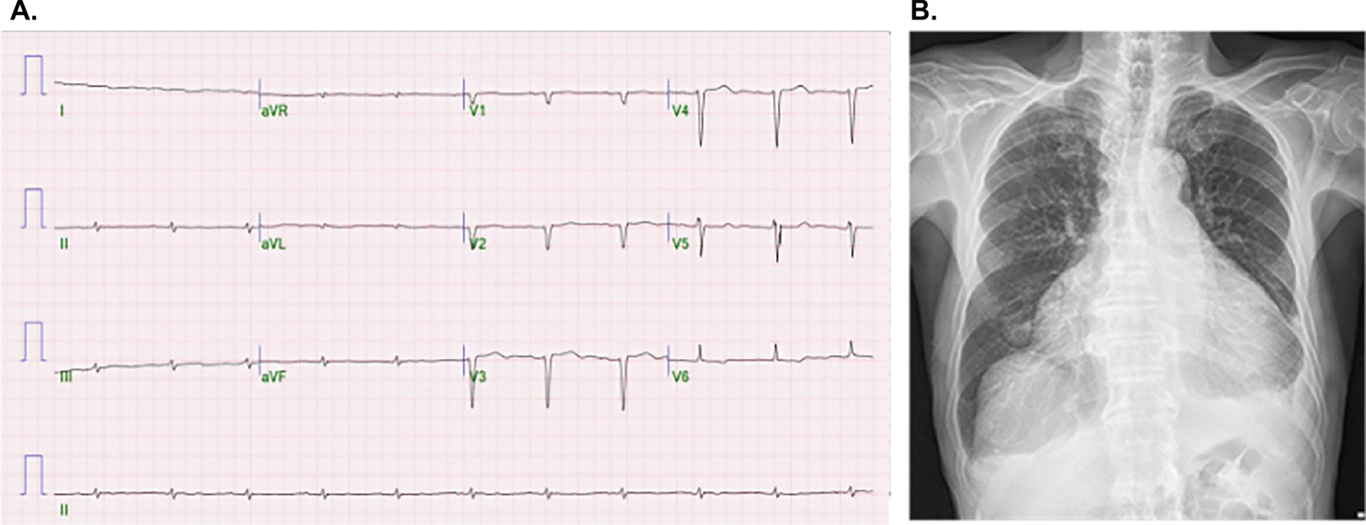 Challenges associated with managing treatment complications in an older patient with cardiac amyloidosis