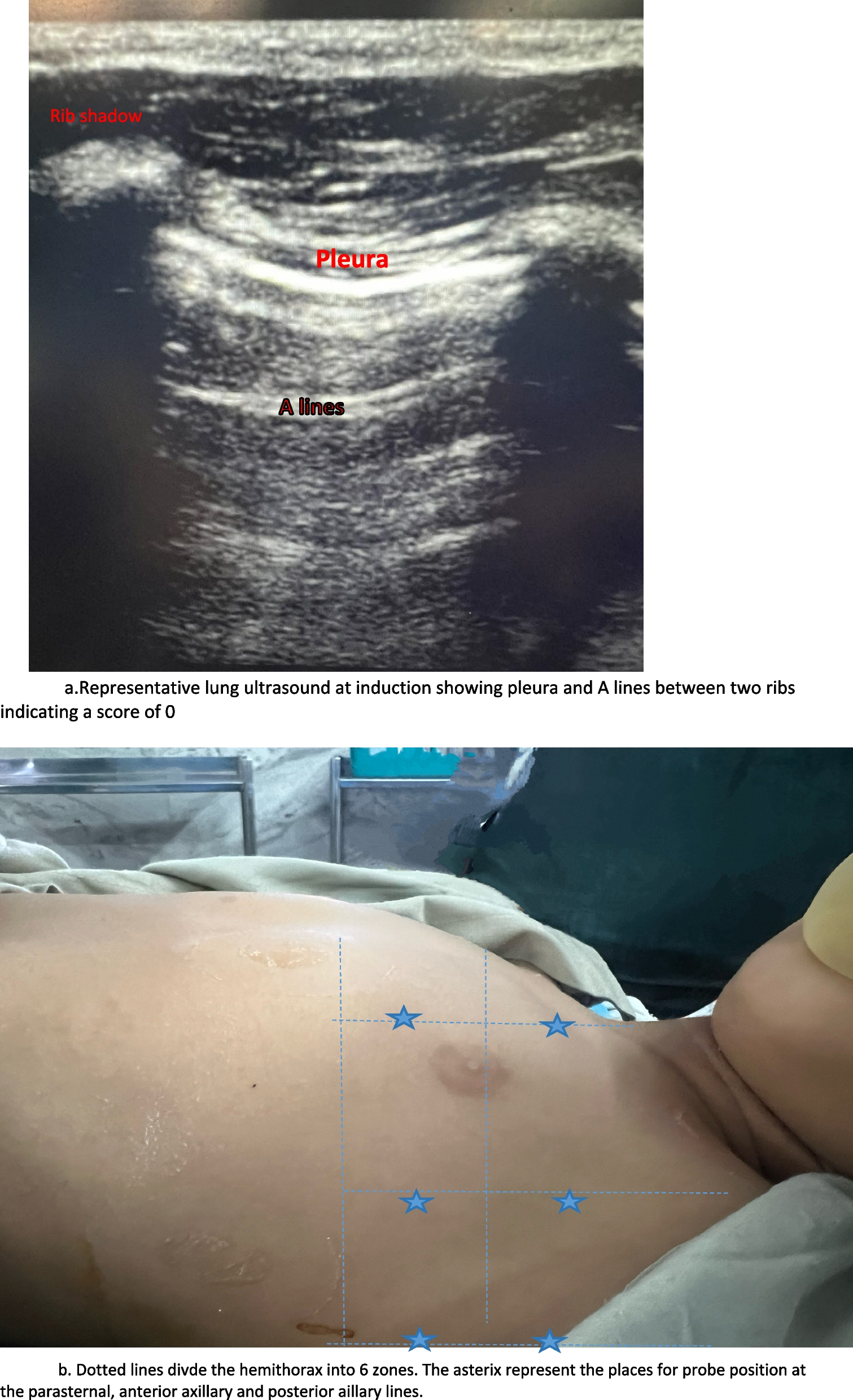 Comparison of the effect of two recruitment manoeuvres to conventional ventilation on lung atelectasis in paediatric laparoscopic surgery- a prospective randomised controlled trial