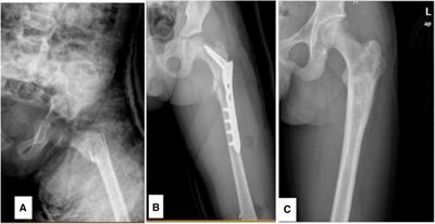 Surgical outcomes of proximal femoral bone cysts in pediatric patients: a retrospective study of 41 cases