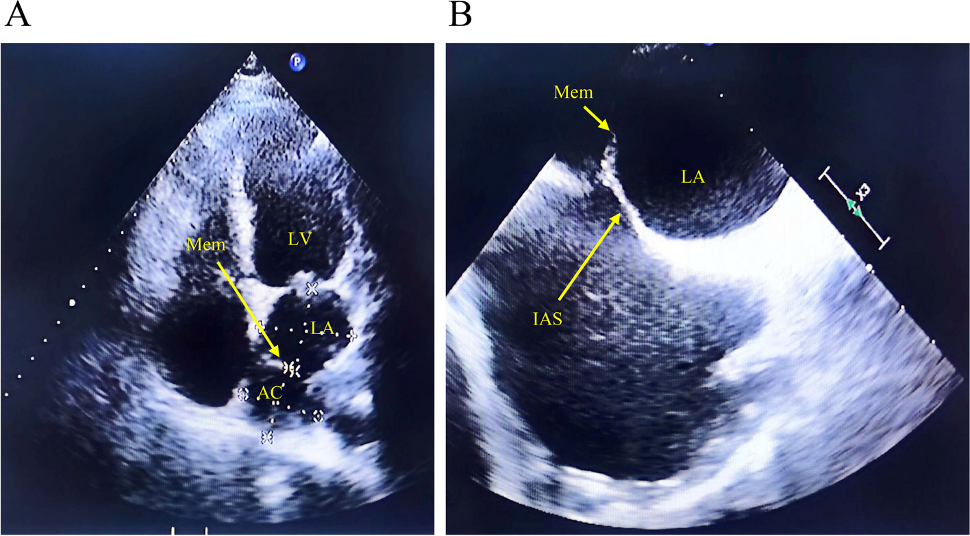 Exploring new frontiers: a rare case of catheter ablation for persistent atrial fibrillation in a patient with cor triatriatum sinister guided by intracardiac echocardiography