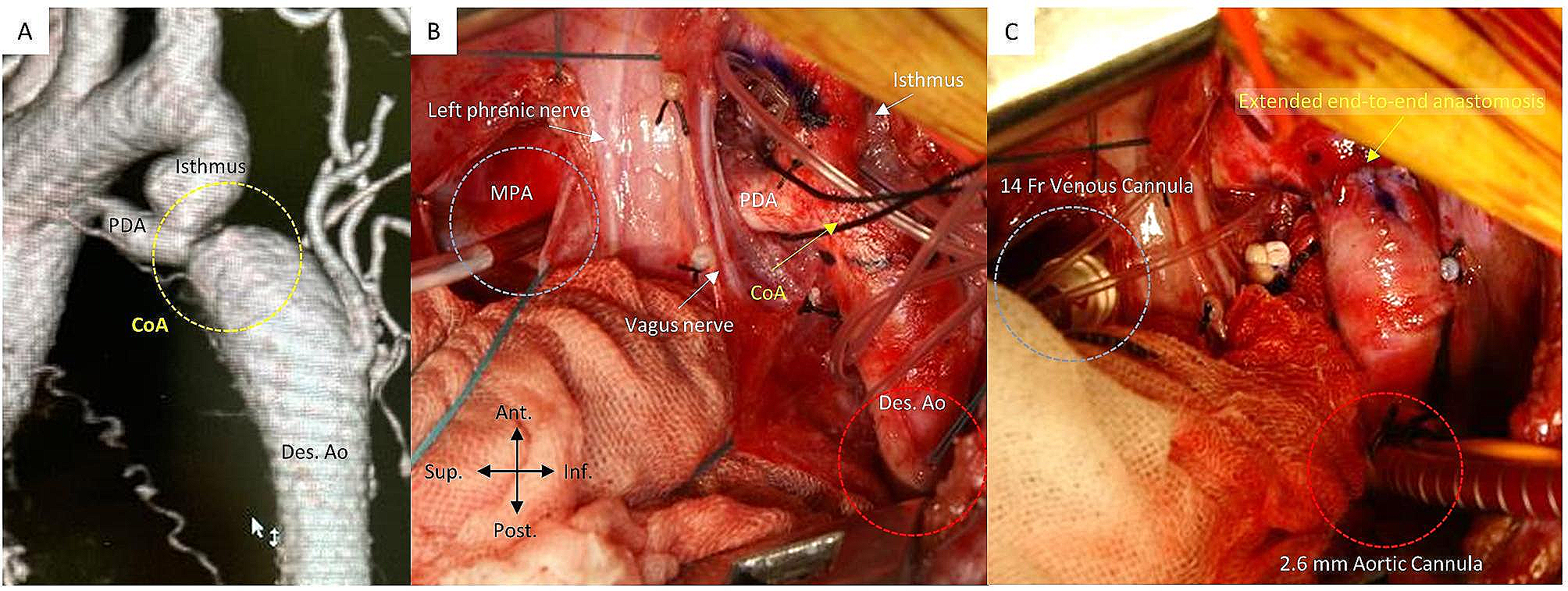 Partial cardiopulmonary bypass through left thoracotomy for coarctation repair in children