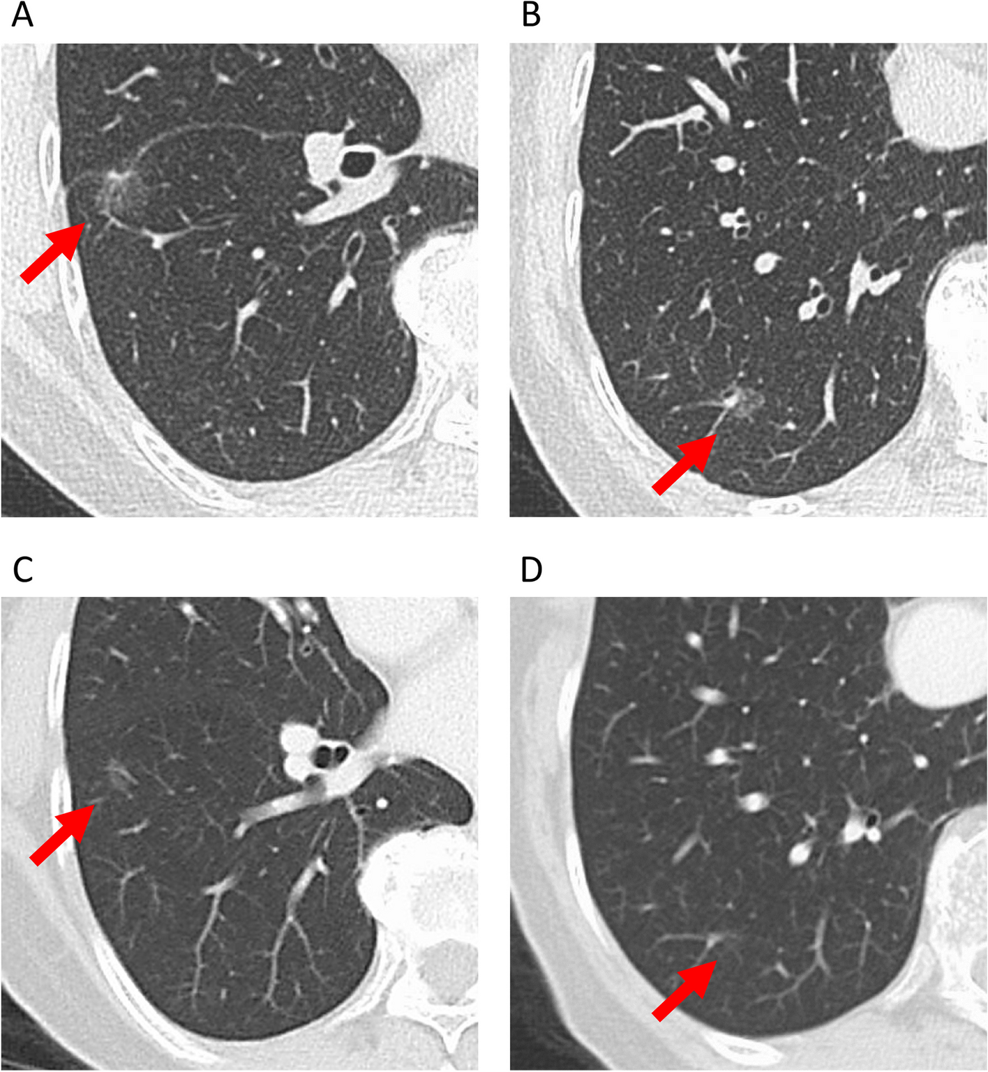 A case of lung metastasis from gastric cancer presenting as ground-glass opacity dominant nodules