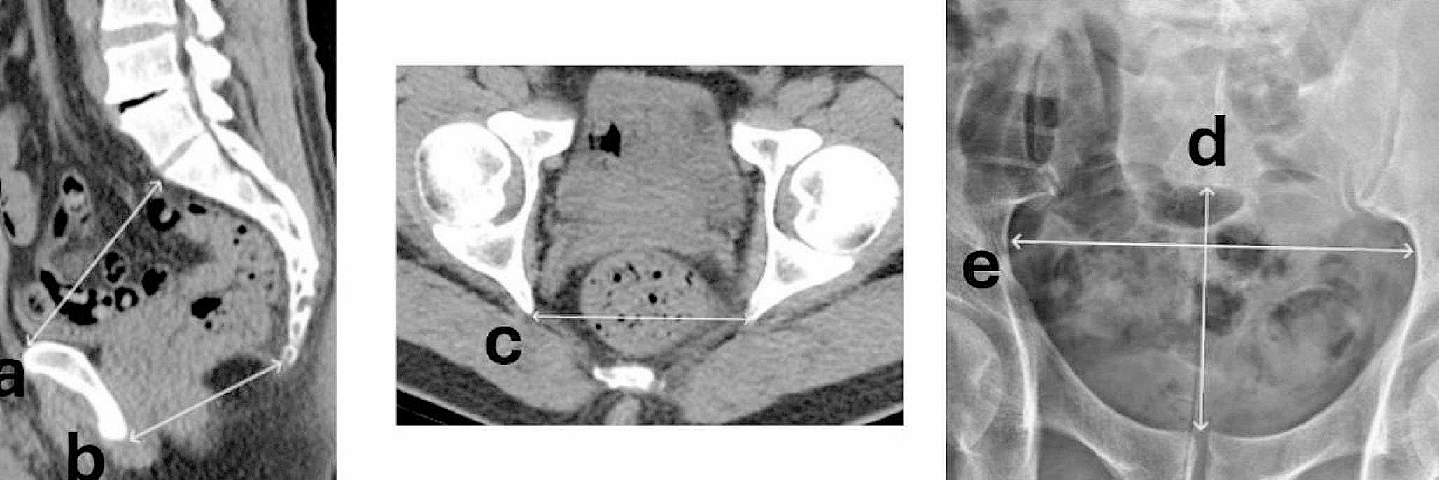 Could radiological parameters help to predict the failure of ureteral access sheath placement