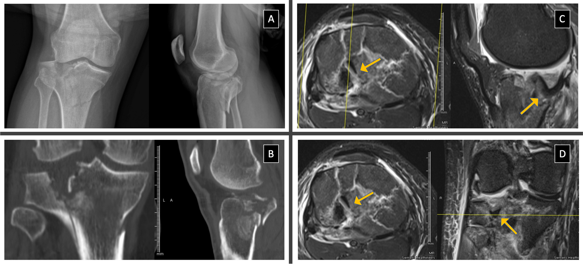Tibial plateau fractures are associated with ligamentous and meniscal injuries. Preoperative evaluation of magnetic resonance imaging influences surgical treatment