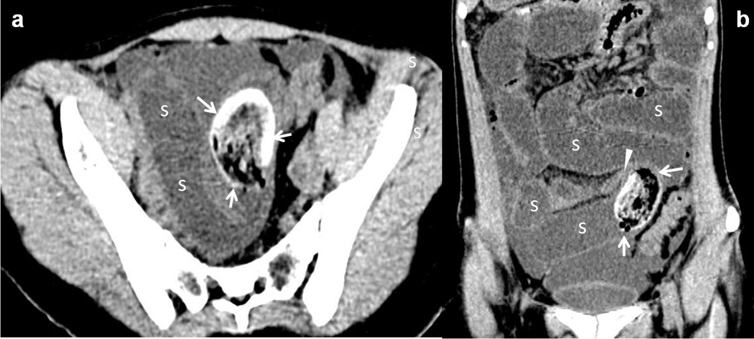 Unusual causes of Small bowel obstruction: a review of the literature and revisited cross-sectional imaging checklist