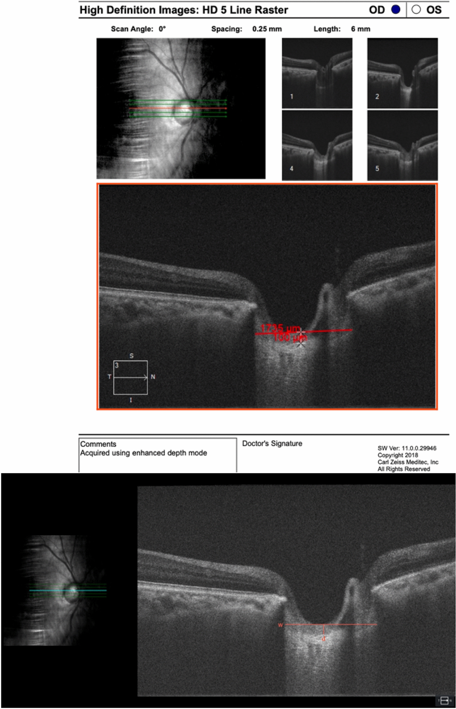 Evaluation of lamina cribrosa curvature index in different types of glaucoma