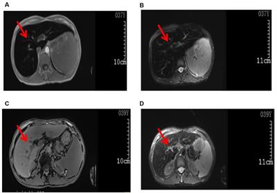 Case report: A rare case of hereditary hemochromatosis caused by a mutation in the HAMP gene in Fuyang, China