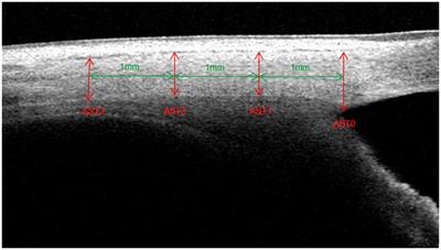 The anterior scleral thickness in primary open-angle glaucoma with high myopia