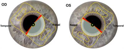 Visual and refractive outcomes of opposite clear corneal incision combined with rotationally asymmetric multifocal intraocular lens implantation